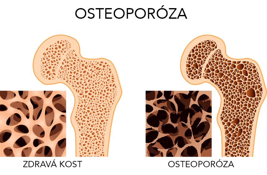 Co Je Osteoporóza a Jak se Léčí 1