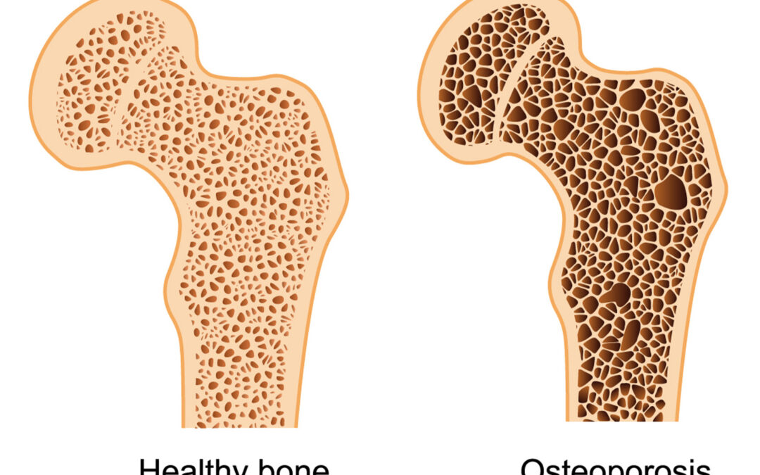 Osteoporóza, Co To Je?