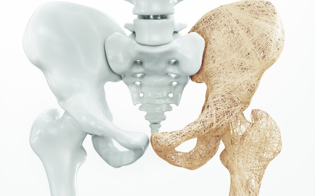 Co Je Osteoporóza a Jak se Léčí